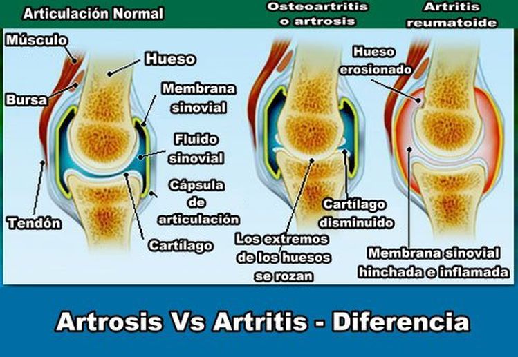 Artritis reumatoide alimentacion