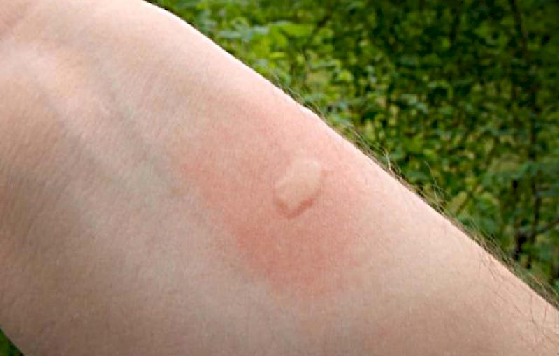 El Remedio Desconocido para Aliviar una Picadura de Mosquito. el-remedio-desconocido-para-aliviar-una-picadura-de-mosquito-0-1629451172-Julia-post-material