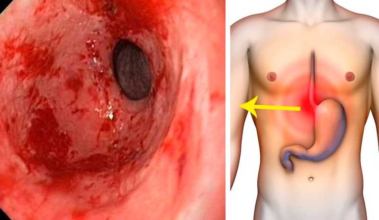 Elimina la Gastritis y la Acidez Estomacal Para Siempre con Este Eficaz Remedio, Protege tu Flora Intestinal elimina-gastritis-la-acidez-estomacal-siempre-este-eficaz-remedio-protege-flora-intestinal-gastritis