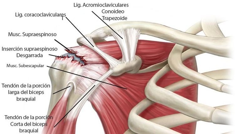 Sufres Dolor en tu Hombro? Se Llama Tendinitis y te Indicamos Como Aliviarlo al Instante! sufres-dolor-hombro-se-llama-tendinitis-te-indicamos-aliviarlo-al-instante-desgarro_del_manguito_rotador