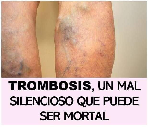 trombosis-un-mal-silencioso-que-puede-ser-mortal-trombosis